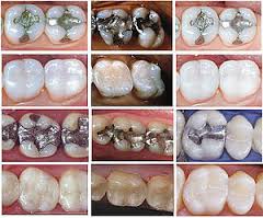 tooth restoration marion