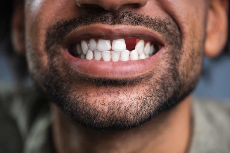 how missing teeth affect your mouth